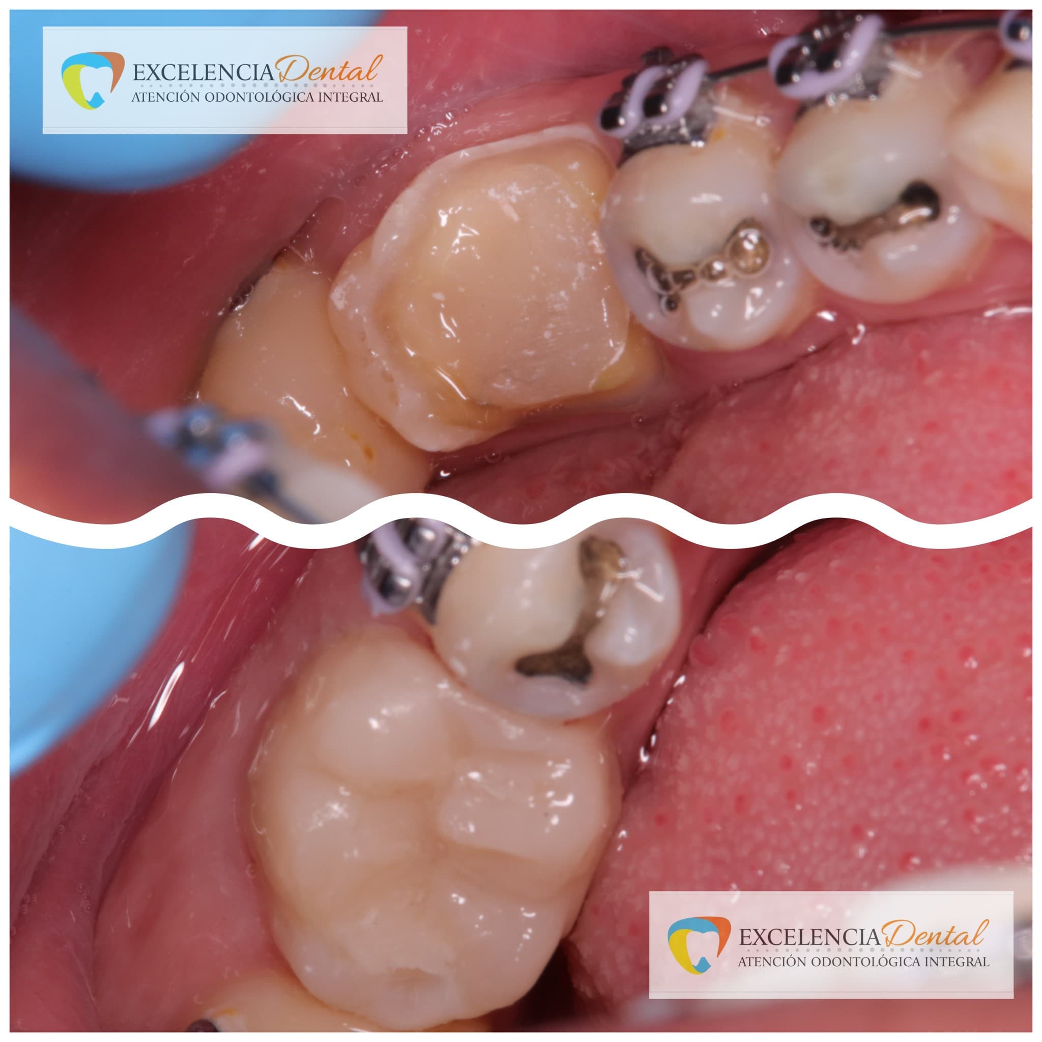 Resultado real de endodoncia y corona — antes y después
